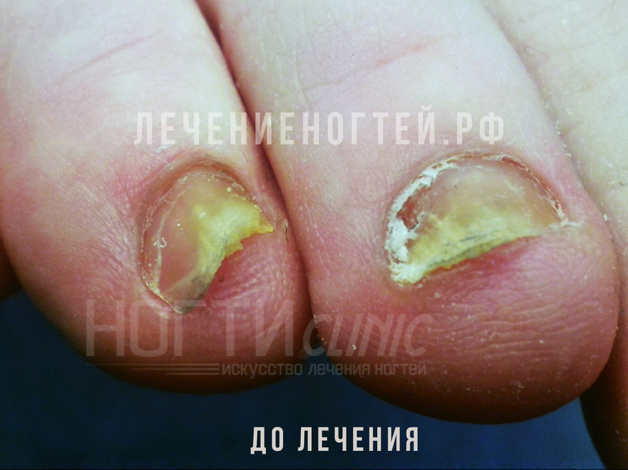 Ногти стопы до лечения: утолщение, жёлто-коричневое окрашивание, крошение свободного края