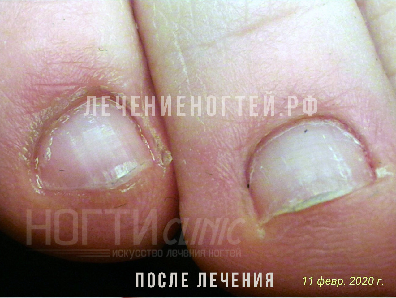 Грибок ногтей после лечения Ляшко А К отзывы