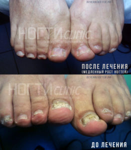 Грибок ногтей после лечения2